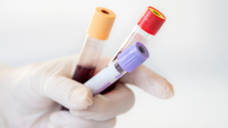 ACP Eigenbluttherapie mittels zentrifugiertem Blut und goldgelben Blutplasma.