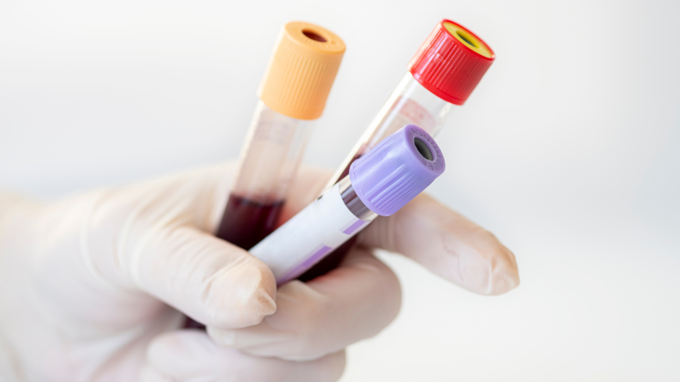 ACP Eigenbluttherapie mittels zentrifugiertem Blut und goldgelben Blutplasma.